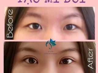 PhẫuThuật Tạo Hình Mí Mắt (Blepharoplasty)